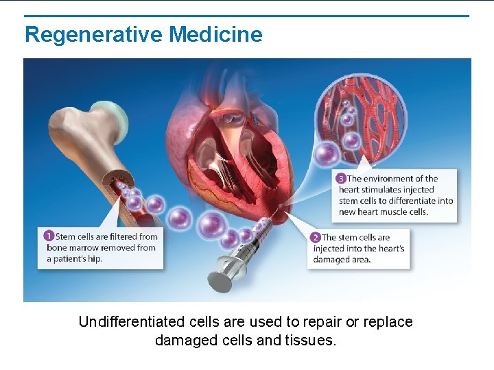 Regenerative Medicine Undifferentiated cells are used to repair or replace damaged cells and tissues.