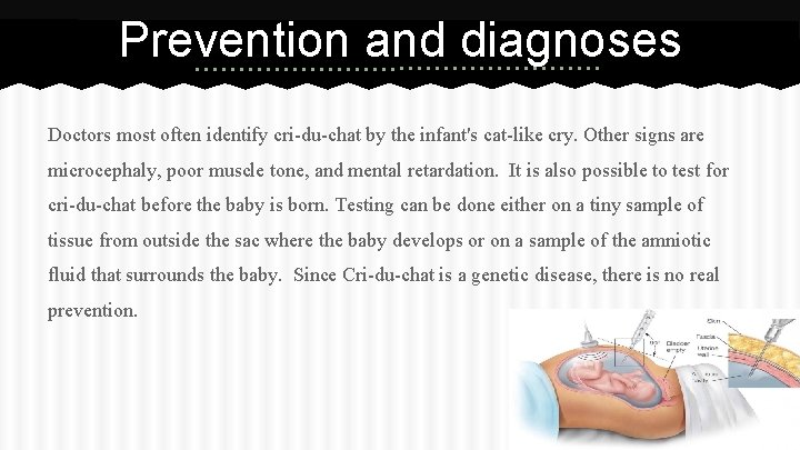 Prevention and diagnoses Doctors most often identify cri-du-chat by the infant's cat-like cry. Other