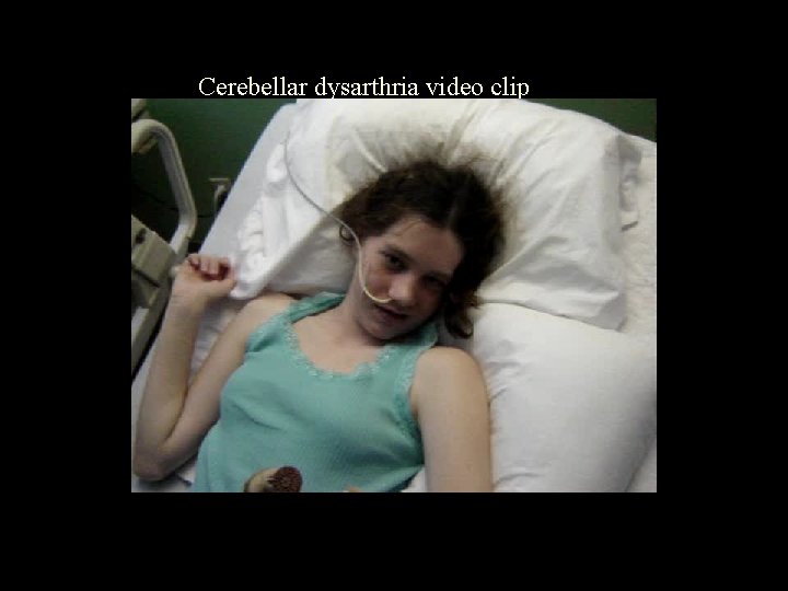 Cerebellar dysarthria video clip 