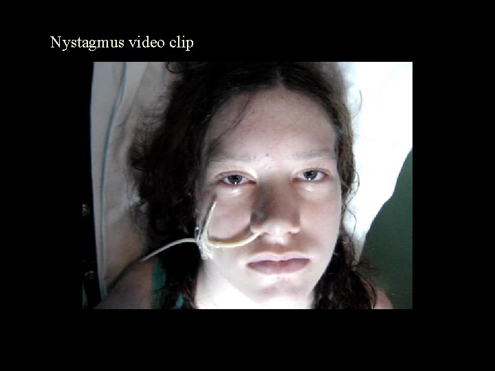 Nystagmus video clip 