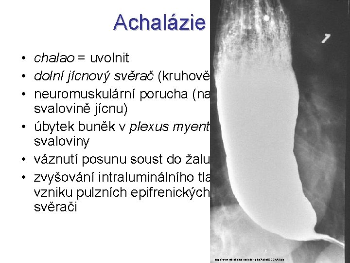 Achalázie • chalao = uvolnit • dolní jícnový svěrač (kruhově zesílená svalovina) • neuromuskulární