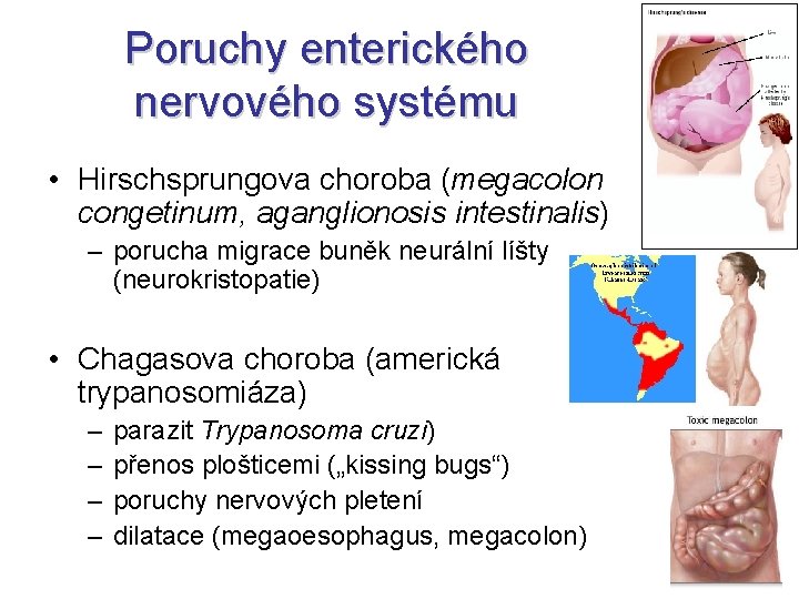 Poruchy enterického nervového systému • Hirschsprungova choroba (megacolon congetinum, aganglionosis intestinalis) – porucha migrace