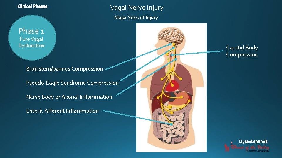Vagal Nerve Injury Major Sites of Injury Phase 1 Pure Vagal Dysfunction Brainstem/pannus Compression