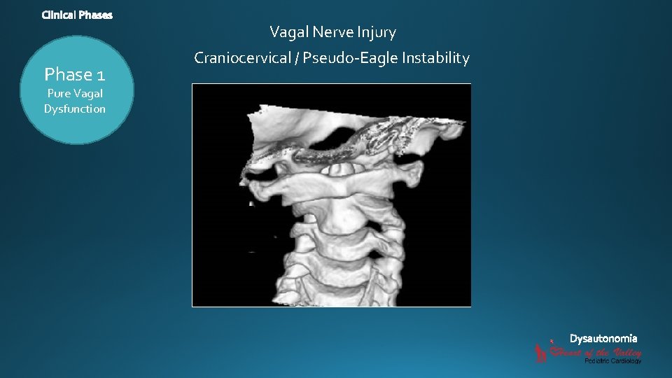 Vagal Nerve Injury Phase 1 Pure Vagal Dysfunction Craniocervical / Pseudo-Eagle Instability 