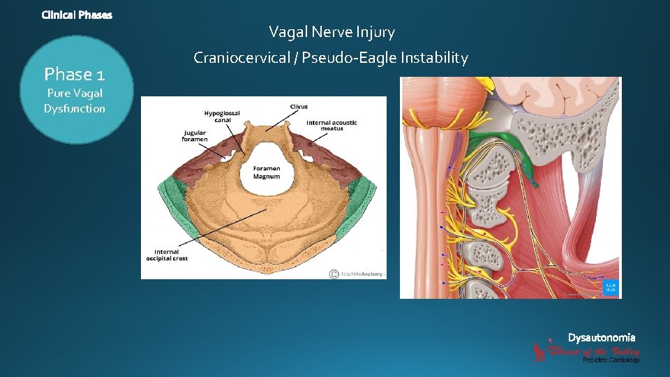 Vagal Nerve Injury Phase 1 Pure Vagal Dysfunction Craniocervical / Pseudo-Eagle Instability 