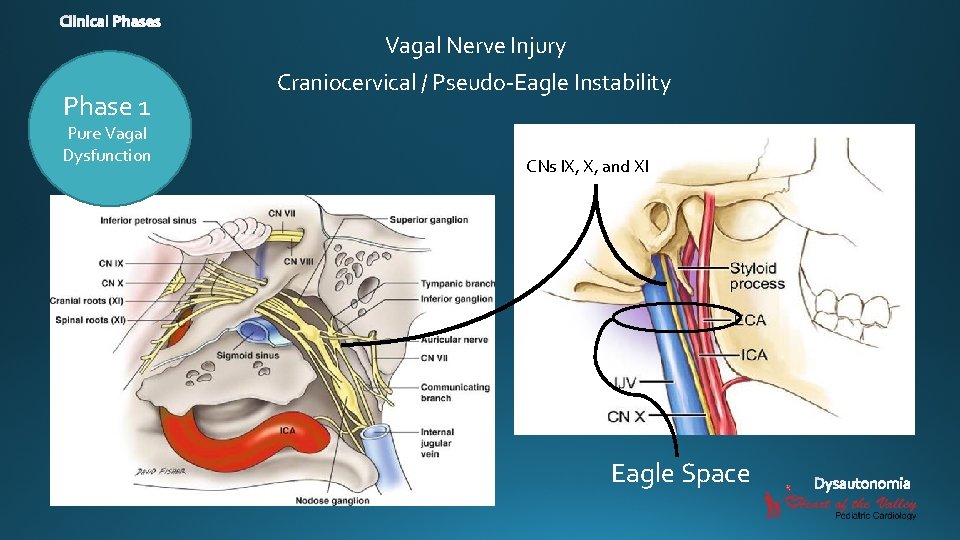 Vagal Nerve Injury Phase 1 Pure Vagal Dysfunction Craniocervical / Pseudo-Eagle Instability CNs IX,