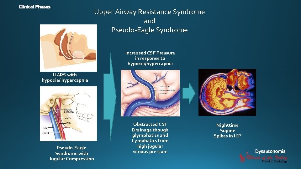 Upper Airway Resistance Syndrome and Pseudo-Eagle Syndrome Increased CSF Pressure in response to hypoxia/hypercapnia