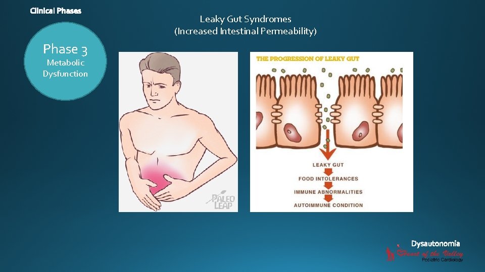 Leaky Gut Syndromes (Increased Intestinal Permeability) Phase 3 Metabolic Dysfunction 