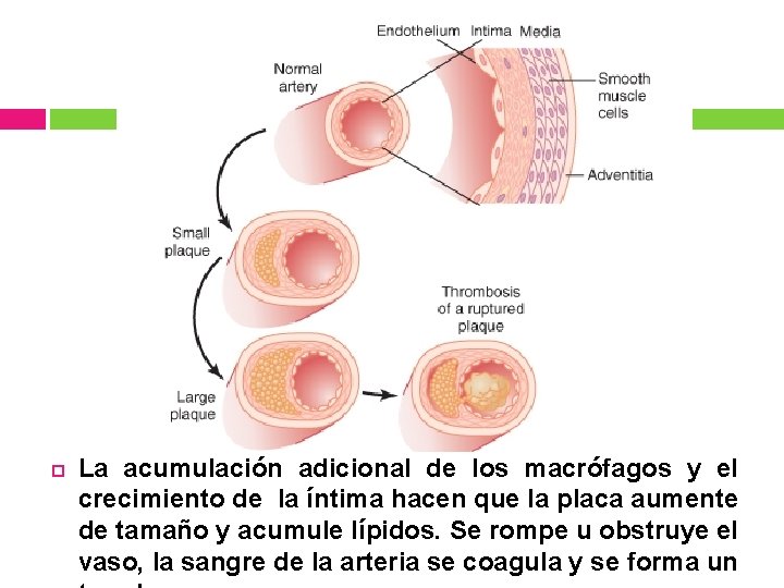  La acumulación adicional de los macrófagos y el crecimiento de la íntima hacen