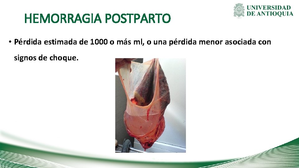HEMORRAGIA POSTPARTO • Pérdida estimada de 1000 o más ml, o una pérdida menor