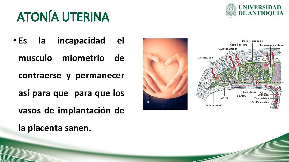 ATONÍA UTERINA • Es la incapacidad el musculo miometrio de contraerse y permanecer así