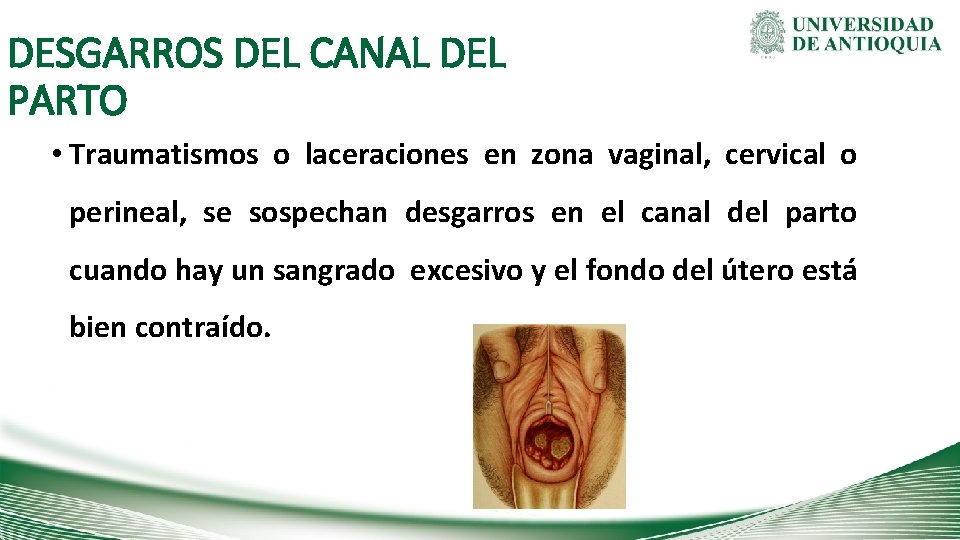 DESGARROS DEL CANAL DEL PARTO • Traumatismos o laceraciones en zona vaginal, cervical o