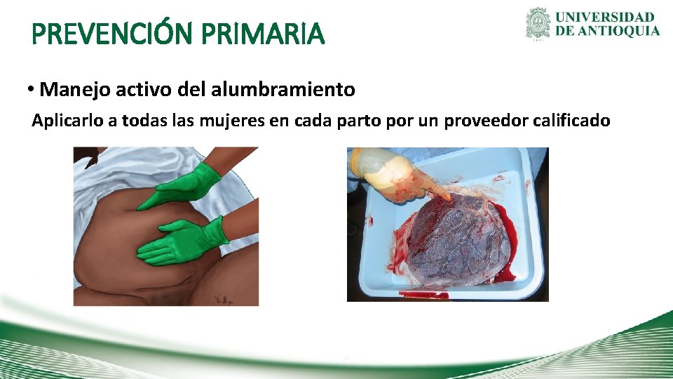 PREVENCIÓN PRIMARIA • Manejo activo del alumbramiento Aplicarlo a todas las mujeres en cada