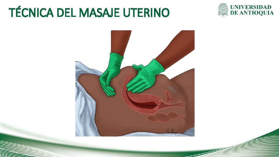 TÉCNICA DEL MASAJE UTERINO 