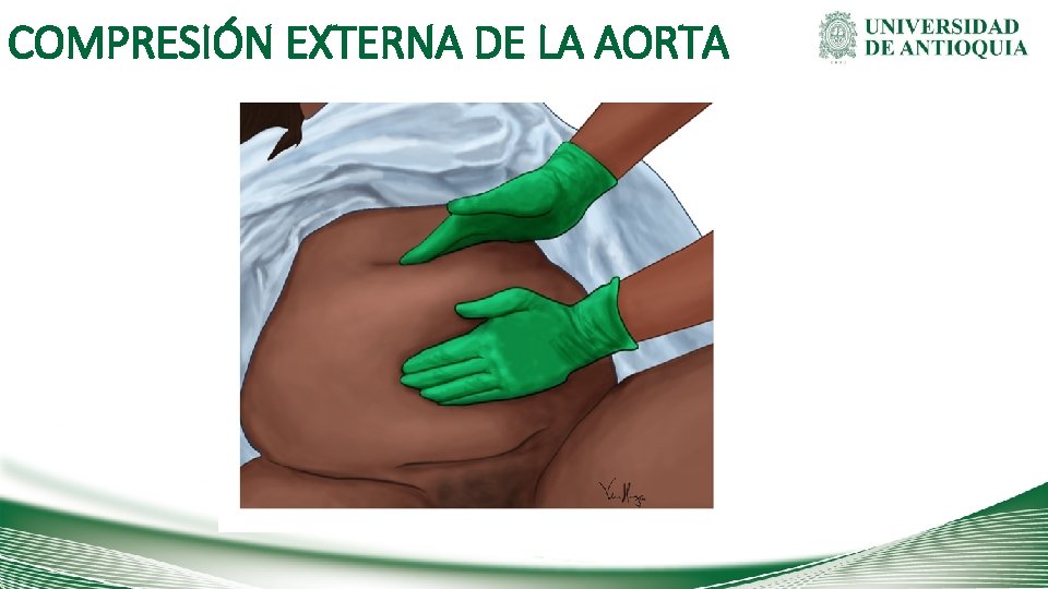 COMPRESIÓN EXTERNA DE LA AORTA 