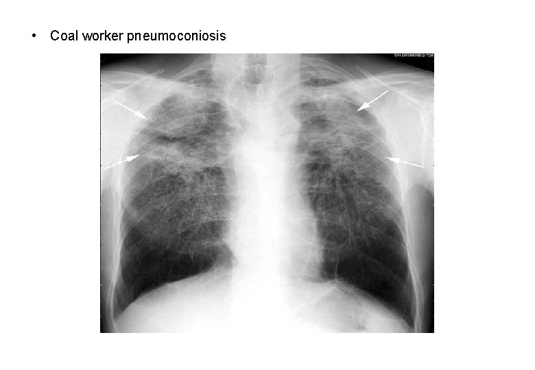  • Coal worker pneumoconiosis 