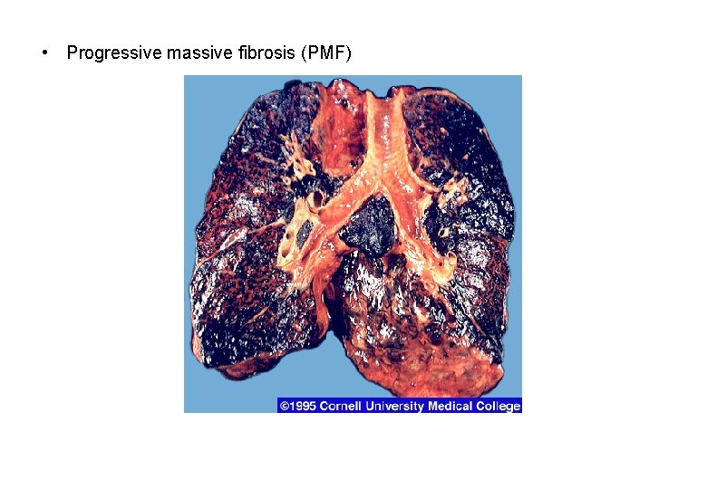  • Progressive massive fibrosis (PMF) 