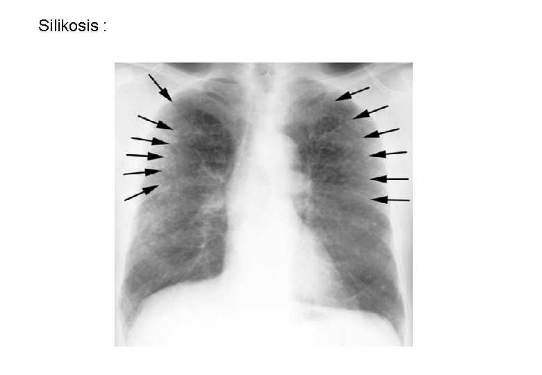 Silikosis : 