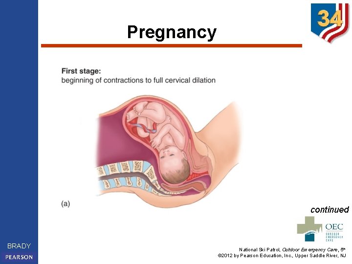 Pregnancy continued BRADY National Ski Patrol, Outdoor Emergency Care, 5 th © 2012 by