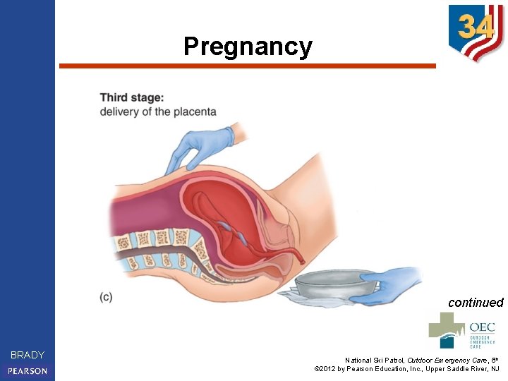 Pregnancy continued BRADY National Ski Patrol, Outdoor Emergency Care, 5 th © 2012 by