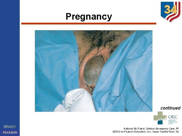 Pregnancy continued BRADY National Ski Patrol, Outdoor Emergency Care, 5 th © 2012 by