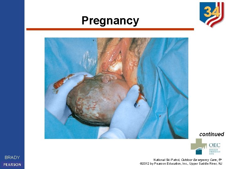 Pregnancy continued BRADY National Ski Patrol, Outdoor Emergency Care, 5 th © 2012 by