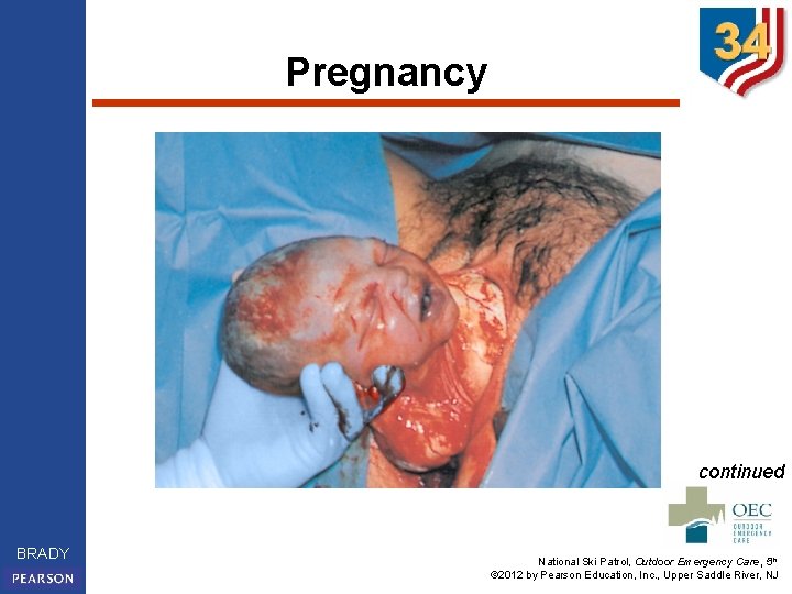 Pregnancy continued BRADY National Ski Patrol, Outdoor Emergency Care, 5 th © 2012 by