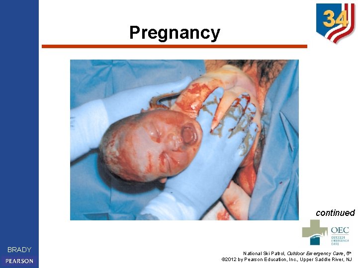 Pregnancy continued BRADY National Ski Patrol, Outdoor Emergency Care, 5 th © 2012 by