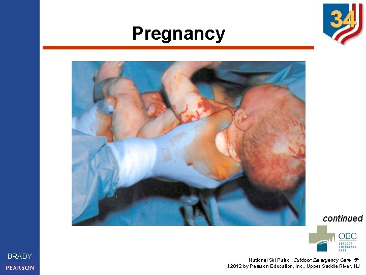 Pregnancy continued BRADY National Ski Patrol, Outdoor Emergency Care, 5 th © 2012 by