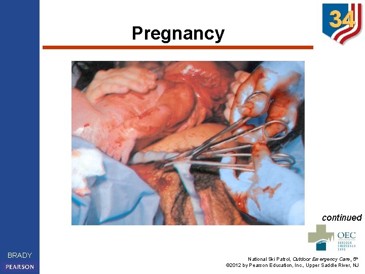 Pregnancy continued BRADY National Ski Patrol, Outdoor Emergency Care, 5 th © 2012 by