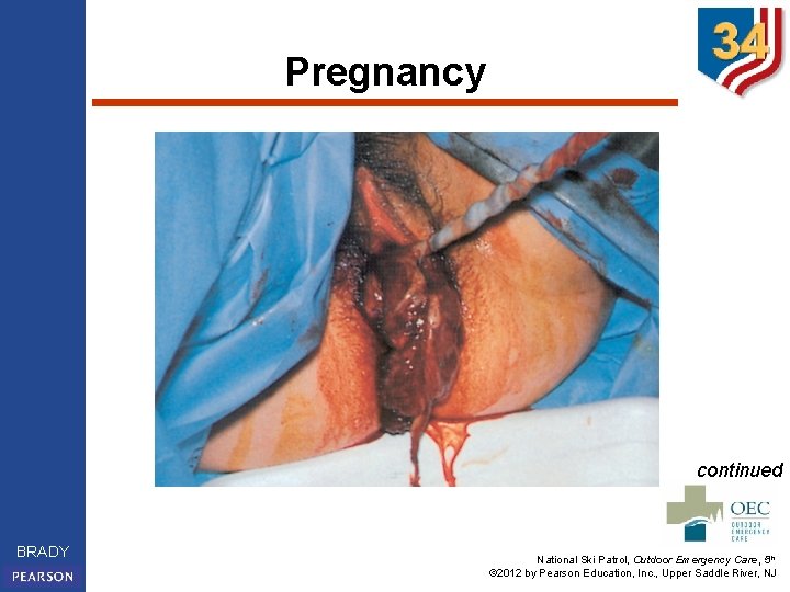 Pregnancy continued BRADY National Ski Patrol, Outdoor Emergency Care, 5 th © 2012 by