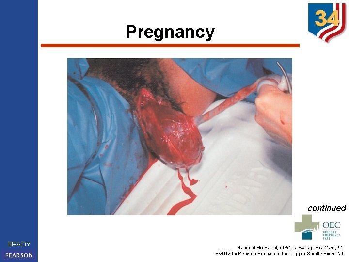Pregnancy continued BRADY National Ski Patrol, Outdoor Emergency Care, 5 th © 2012 by
