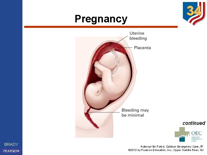 Pregnancy continued BRADY National Ski Patrol, Outdoor Emergency Care, 5 th © 2012 by