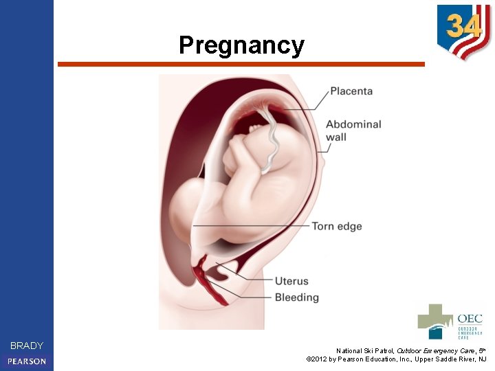 Pregnancy BRADY National Ski Patrol, Outdoor Emergency Care, 5 th © 2012 by Pearson