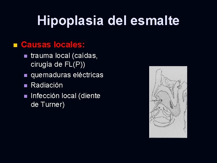 Hipoplasia del esmalte n Causas locales: n n trauma local (caídas, cirugía de FL(P))
