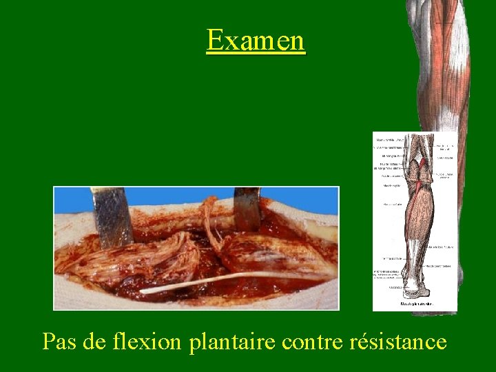 Examen Pas de flexion plantaire contre résistance 