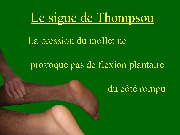 Le signe de Thompson La pression du mollet ne provoque pas de flexion plantaire