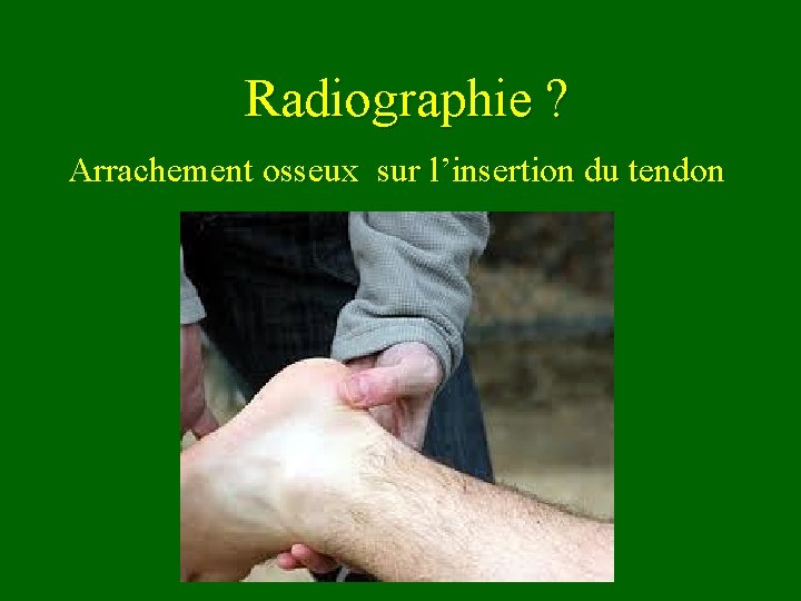 Radiographie ? Arrachement osseux sur l’insertion du tendon 