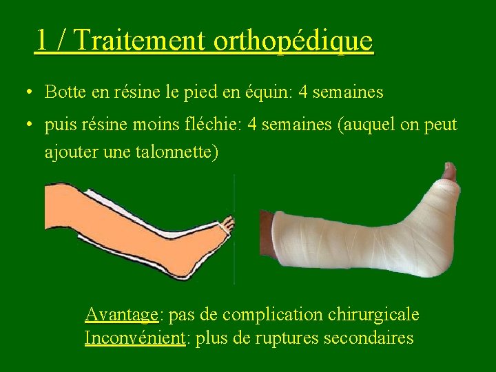 1 / Traitement orthopédique • Botte en résine le pied en équin: 4 semaines