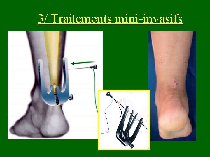 3/ Traitements mini-invasifs 