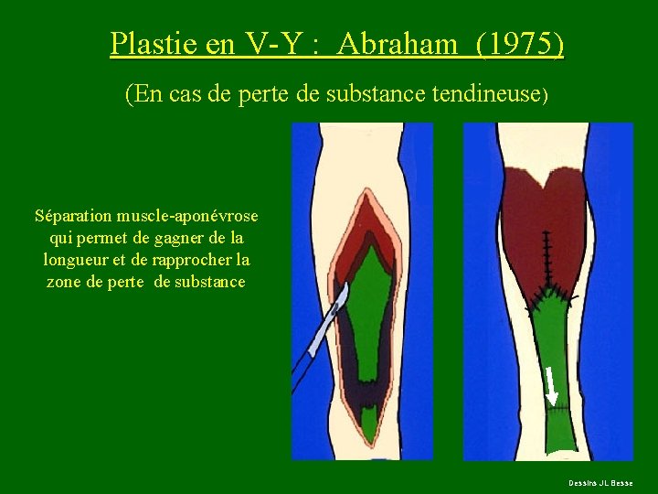 Plastie en V-Y : Abraham (1975) (En cas de perte de substance tendineuse) Séparation