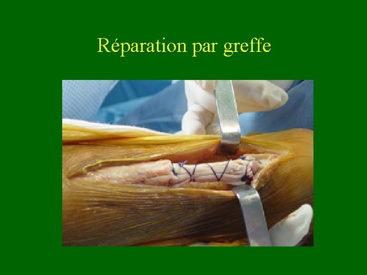 Réparation par greffe 