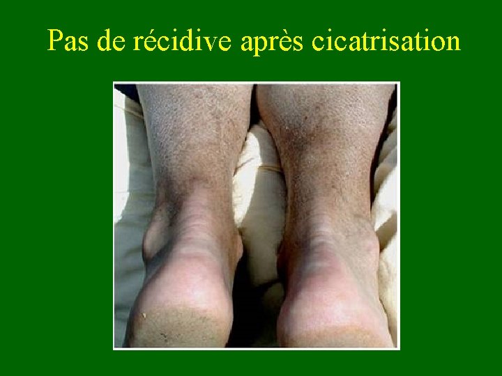 Pas de récidive après cicatrisation 