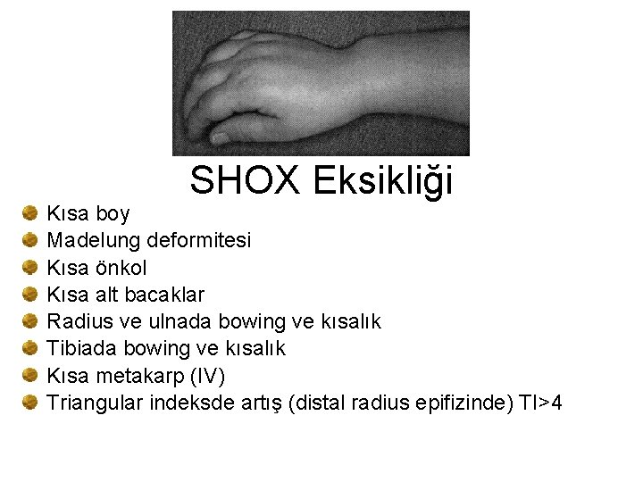 SHOX Eksikliği Kısa boy Madelung deformitesi Kısa önkol Kısa alt bacaklar Radius ve ulnada