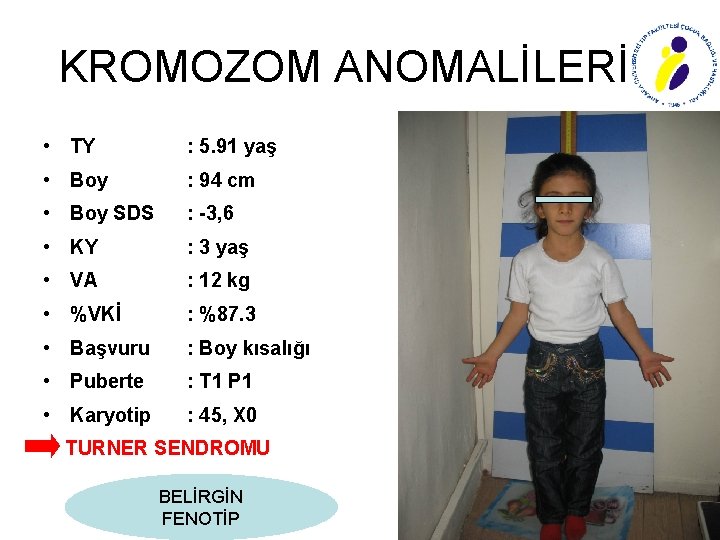 KROMOZOM ANOMALİLERİ • TY : 5. 91 yaş • Boy : 94 cm •