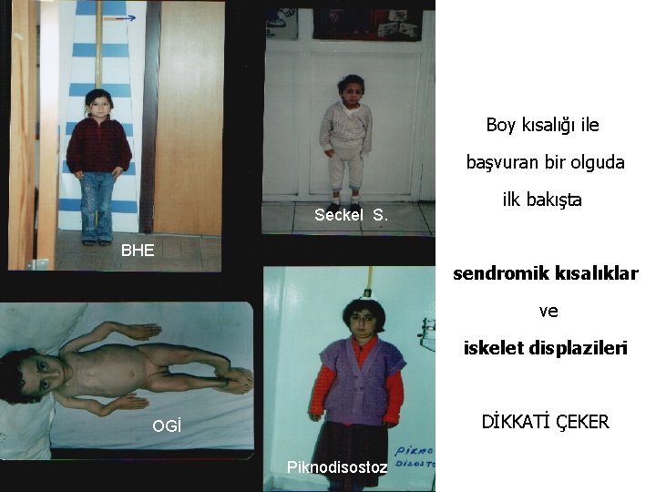 Boy kısalığı ile başvuran bir olguda Seckel S. ilk bakışta BHE sendromik kısalıklar ve