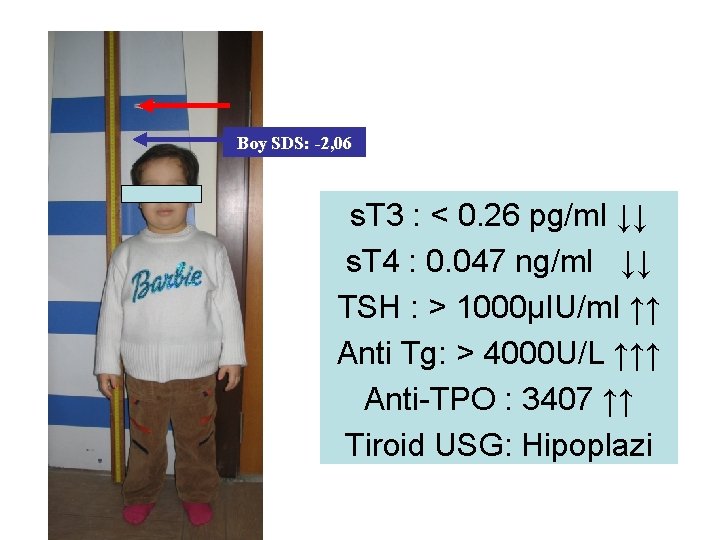 Boy SDS: -2, 06 s. T 3 : < 0. 26 pg/ml ↓↓ s.