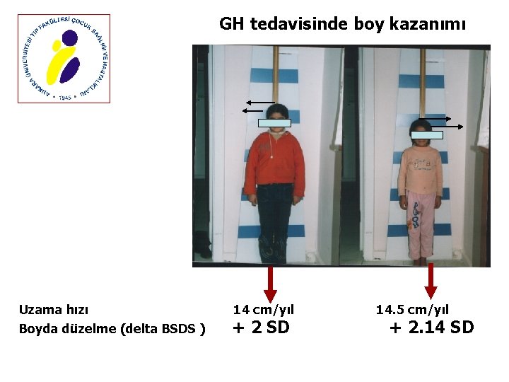 GH tedavisinde boy kazanımı Uzama hızı Boyda düzelme (delta BSDS ) 14 cm/yıl +