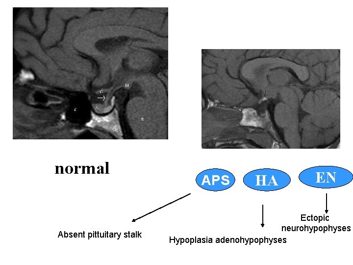 normal Absent pittuitary stalk APS HA EN Ectopic neurohypophyses Hypoplasia adenohypophyses 