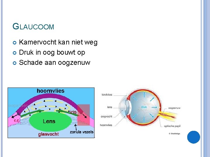 GLAUCOOM Kamervocht kan niet weg Druk in oog bouwt op Schade aan oogzenuw 